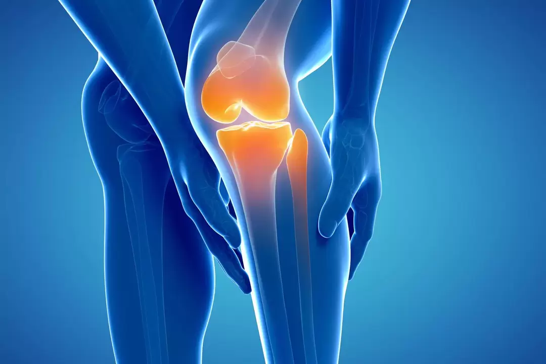 Артроз коленного сустава (гонартроз, деформирующий остеоартроз)